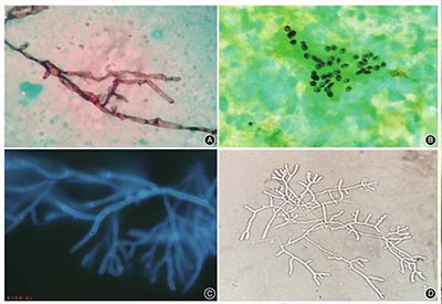 真菌荧光染色剂：革新真菌感染检测，助力高效医疗