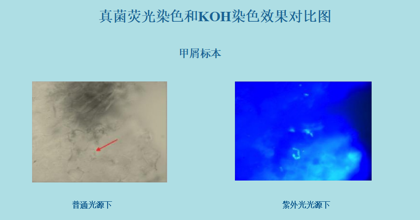 真菌荧光染色和KOH染色效果对比图