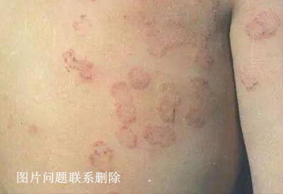 真菌染色液是我们常见的诊断真菌感染的试剂消灭真菌的方法原理都有哪些？