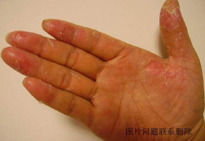 真菌荧光检测试剂厂家介绍特定季节手掌和脸上干燥脱皮是不是真菌感染你有类似经历吗?