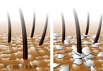 真菌免疫荧光染色能够诊断出头皮屑特别多可能是因为真菌感染的原因