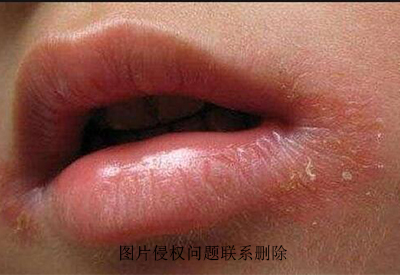   真菌免疫荧光显色试剂介绍春季有的人嘴角边红红的痒痒的可能是真菌感染