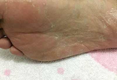 皮肤真菌荧光染色剂检测呈阳性生活我们该怎么有效的做好预防和处理？