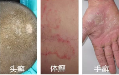 【新技术】皮肤科真菌荧光染色液原理通过真菌镜检或是培养来确诊“癣”